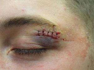 Eyebrow laceration